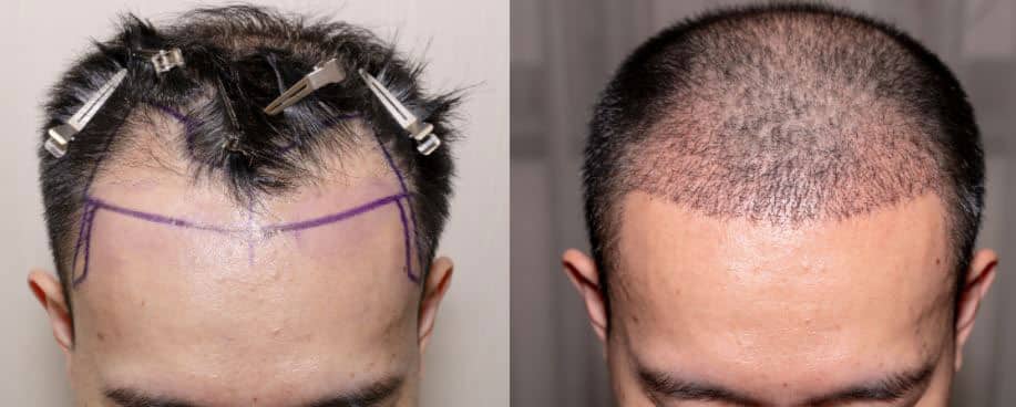 Stop Chasing Your Receding Hairline - TM Hair