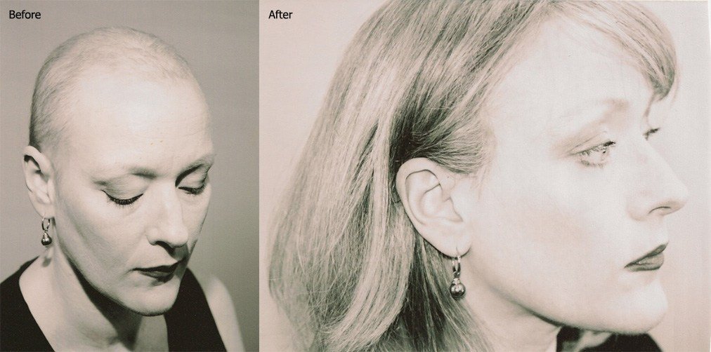 Chemotherapy Hair Loss and Solutions6