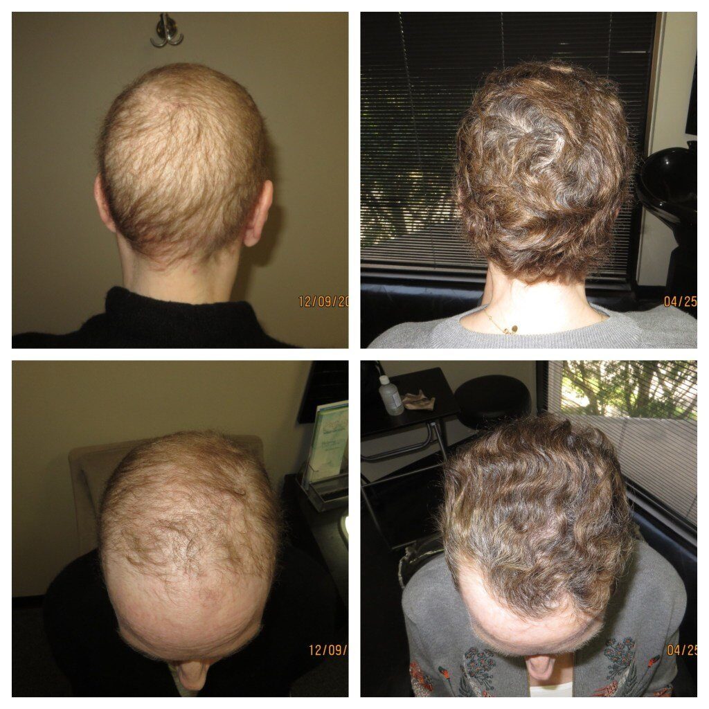 Chemo Hair Regrowth and Solutions | TM Hair