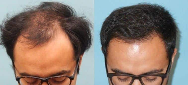 Follicular Unit Extraction Fue