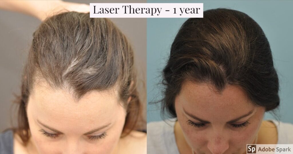 Laser Hair Therapy | TM Hair
