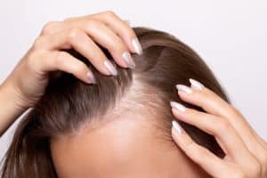 TM Hair Insights: Expert Advice & Hair Loss Blogs 13 Janeberry