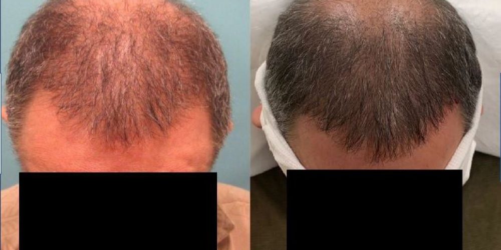 Follicular Unit Extraction Fue4